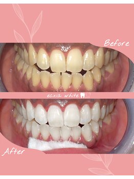 エクシアホワイトニング 札幌中島公園店/Before After［ホワイトニング］