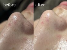 ビビ(Vivi)/毛穴洗浄