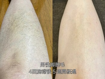 エクレ 柏店(EKURE)/メンズ脚脱毛