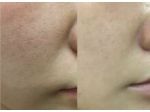 トゥモロー(TOMORROW)/乾燥している毛穴の引き締め