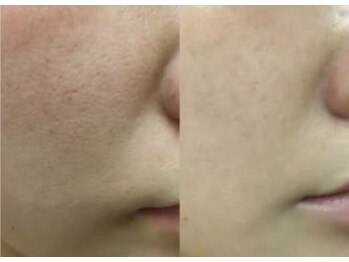 トゥモロー(TOMORROW)/乾燥している毛穴の引き締め