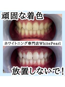 ホワイトパール 前橋(WhitePearl)/【ビフォーアフター】