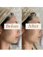 クリニカルホワイトケア 和泉府中店(クリニカルWHITEケア)/小顔リフトアップ(1回)
