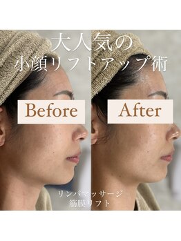 クリニカルホワイトケア 和泉府中店(クリニカルWHITEケア)/小顔リフトアップ(1回)