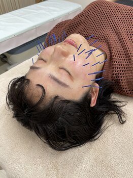 ミレ(mirae)/美容鍼