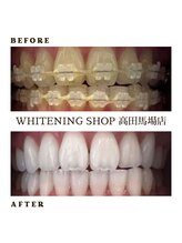 ホワイトニングショップ 高田馬場店/ホワイトニングBeforeAfter