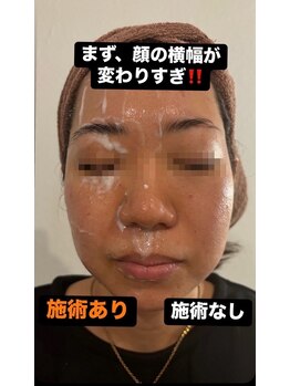 ローズマリー(rosemary)/【サーマトリックス】半顔の効果