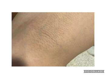 スリーアイ(THREE AI)/◆わき脱毛４回目◆