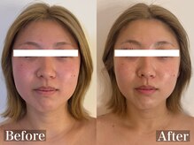 ラナ(Lana)/筋膜小顔リフト