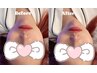 【満員御礼】トライポーラVライン小顔Instagramモニター様