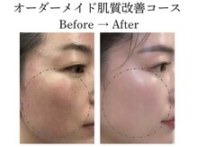 スターティス(STATICE)の雰囲気（天然由来成分のピーリング剤を使用した、オリジナル肌質改善）
