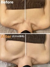 ラビス(RAVIS)/片方施術で劇的変化！！