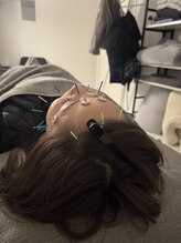 ラフテル鍼灸整骨院/しわなどのケアに美容鍼◎