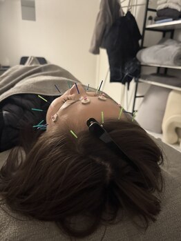 ラフテル鍼灸整骨院/しわなどのケアに美容鍼◎