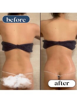 オーロラ(Aurora)/痩身ダイエットコースの２回目