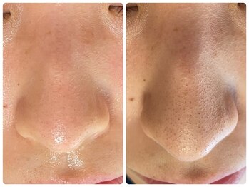 ラヴィ(Ravi)/鼻のお悩みケア