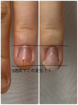 ココ ネイル サロン アンドスクール(COCO.NAIL SALON＆SCHOOL)/爪噛みケア 長さ出し
