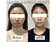 ハリカ 東京新宿店(HARIKA)/SNSで話題のブライダル美容鍼♪