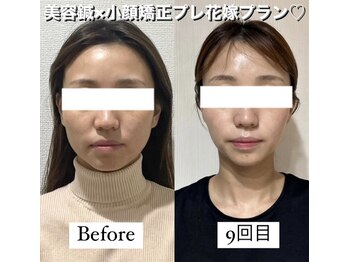 ハリカ 東京新宿店(HARIKA)/SNSで話題のブライダル美容鍼♪