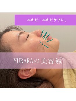 ユララ(YURARA)/ニキビケアに美容鍼！！