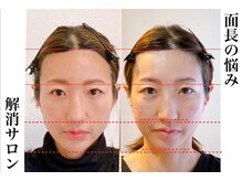 小顔22 ボルティ 赤坂支店(Bolty)/【面長】が大きく変化