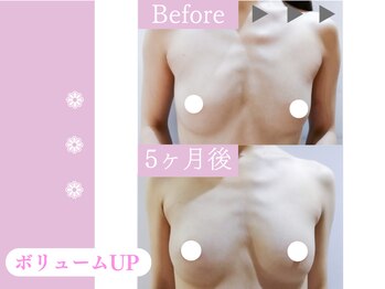 キアナ 横浜店(Kiana)/バストアップBefore After