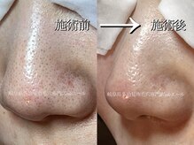 エール(aile)/長年の悩み！頑固な毛穴の黒ずみ