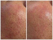 フェリス(FELIZ)/プラズマフェイシャル