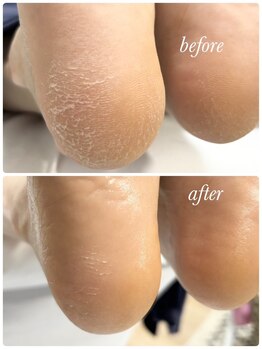 ペディラボ 荻窪店(Pedi Labo)/足裏角質ケア　症例