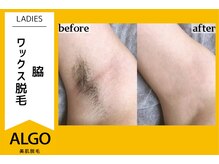 アルゴ 越前店(ALGO)/アルゴ式WAX脱毛＋光脱毛