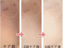 カピリナスパ(Ka.Pilina Spa)/シミケア経過