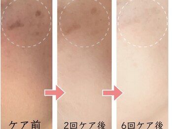 カピリナスパ(Ka.Pilina Spa)/シミケア経過