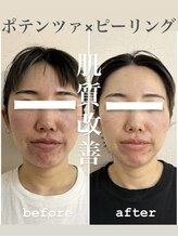 リノ ショウナン(LINO SHONAN)/ポテンツァ×ハーブピーリング