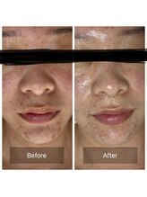 ビジュープラス 筑西下館店(Bijou+)/【30代お悩み】ニキビ／2回目/1M