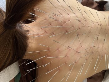 もりさわ治療院 与力町治療室 &nbsp;トサカ(TOSAKA)の写真/【インパクト大のルート鍼施術】太い鍼を多数使用し、蓄積されたコリをしっかりほぐします！根本改善にも◎