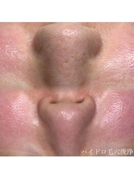 モンド(MONDO)/毛穴洗浄