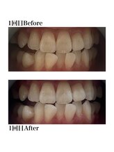 ホワイトニングショップ 三田店/Before After/1回（初回体験）