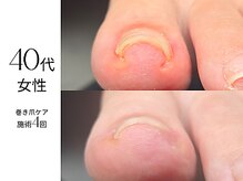 フットケア クラッシー(footcare classy)/巻き爪と剥離が同時進行？！(2)