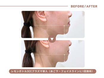 イエス マイサロン(yes My Salon)/レモンボトル施術例