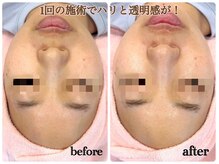 シルク(Cilk)/ハリ、ツヤ、リフトアップ◎