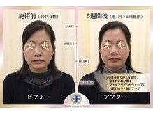 井原鍼灸整骨院/IAB美容鍼