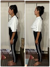 ミリー(mirrie)/フェムケア矯正before/after