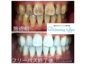 ホワイトニングサロン 熊本店
