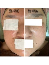 カヌヌ(Kanunu)/肌質改善トリートメント