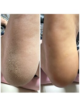 クク(KUKU)/本格角質ケアでツルツルかかとに