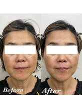 コリー(Kolly)/リフェイス"全顔初回"