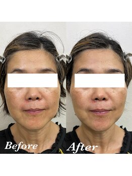 コリー(Kolly)/リフェイス"全顔初回"