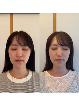 イロドリ 浦和美園(irodori)/小顔整体Before＆Afte r(4回目)