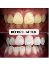 ホワイトニングサロン 宝塚/Before&After美白ホワイトニング
