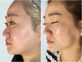 仙豆のちから 自由が丘店/テラボーラー1年後の変化